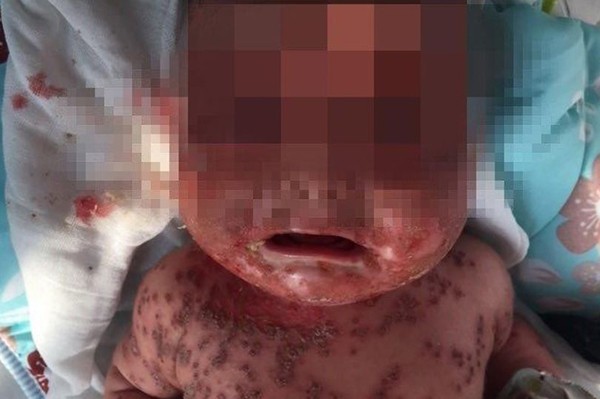 Bé trai 3 tháng tuổi viêm màng não do thường xuyên bị mẹ hôn môi ảnh 1