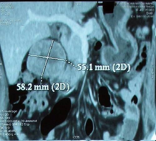 Bị đau tức vùng lưng, cô gái 24 tuổi mắc ung thư thận ảnh 1