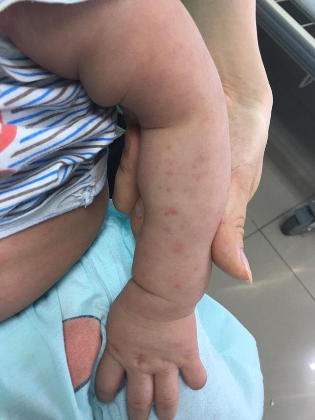 Làm gì khi bị sốt giữa mùa dịch sốt xuất huyết? ảnh 1