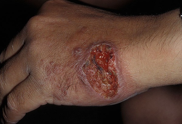 Căn bệnh lạ khiến các chiến binh IS có diện mạo giống xác sống ảnh 2