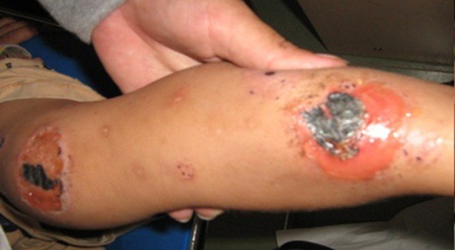 Mùa mưa lũ đề phòng các bệnh về da ảnh 1