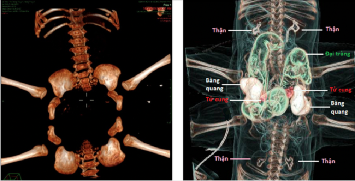 Chuẩn bị mổ tách cặp song sinh dính liền vùng bụng chậu ảnh 1