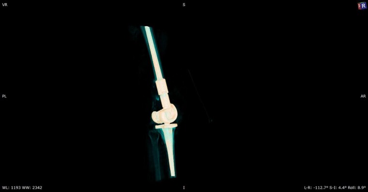 Thay thế xương khớp nhân tạo in 3D cho bệnh nhân khuyết tật suốt 18 năm ảnh 2