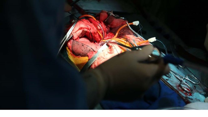 Bệnh nhân đầu tiên tại Việt Nam ghép phổi thành công từ người hiến chết não ảnh 1