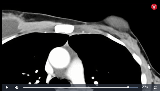 Thử nghiệm kỳ diệu: ung thư giai đoạn cuối tự khỏi! ảnh 2