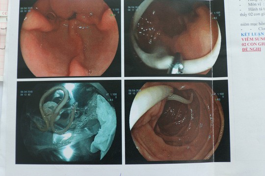 Giun đũa dài như con lươn chui vào ruột người phụ nữ ảnh 1