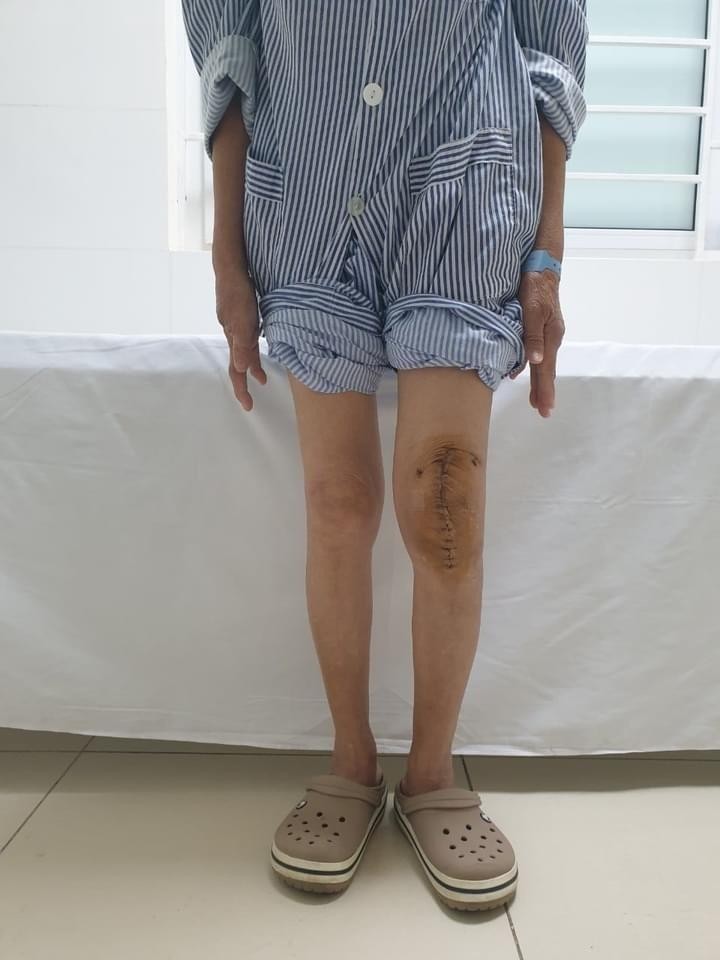 Lần đầu tiên tại Việt Nam thay thành công khớp gối nhân tạo cho người mắc lao khớp gối ảnh 1