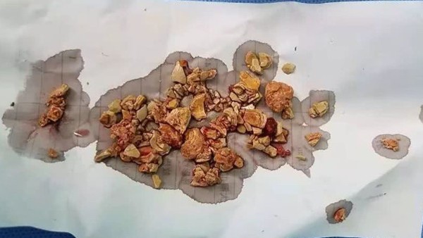 Bé 5 tháng tiểu ra máu, thận đầy sỏi do mẹ cai sữa sớm ảnh 2