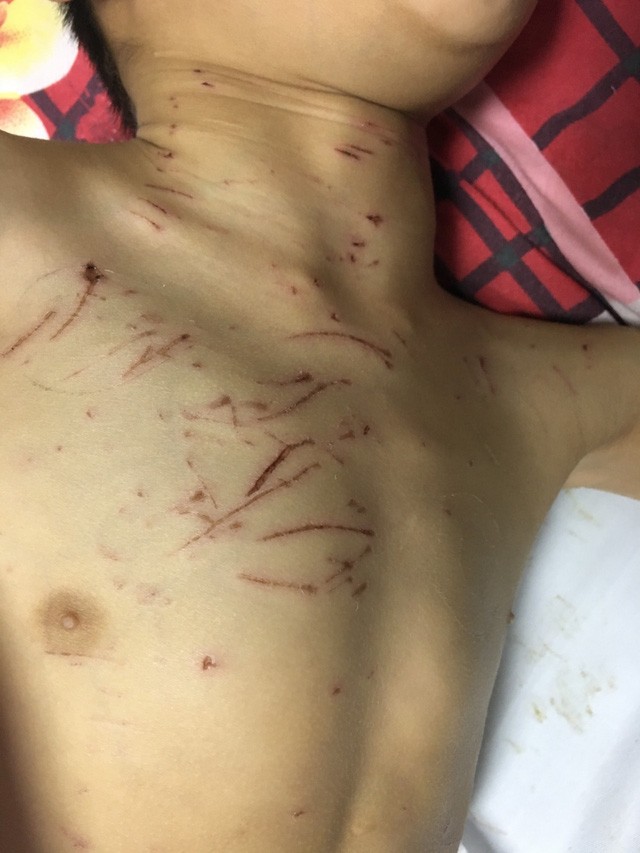 Bé trai bại não bị 4 con chó nhà cắn nát bộ phận sinh dục ảnh 1