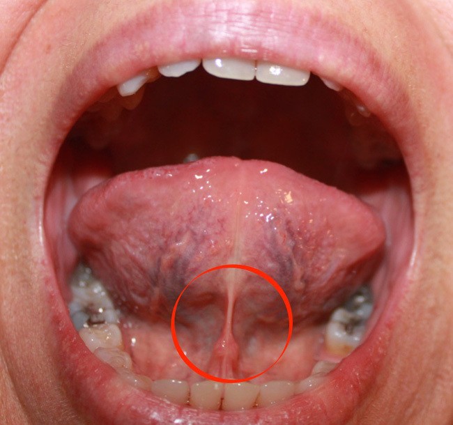 Sự thật về hiện tượng ‘nuốt lưỡi’, có thể xảy ra với những ai? ảnh 1