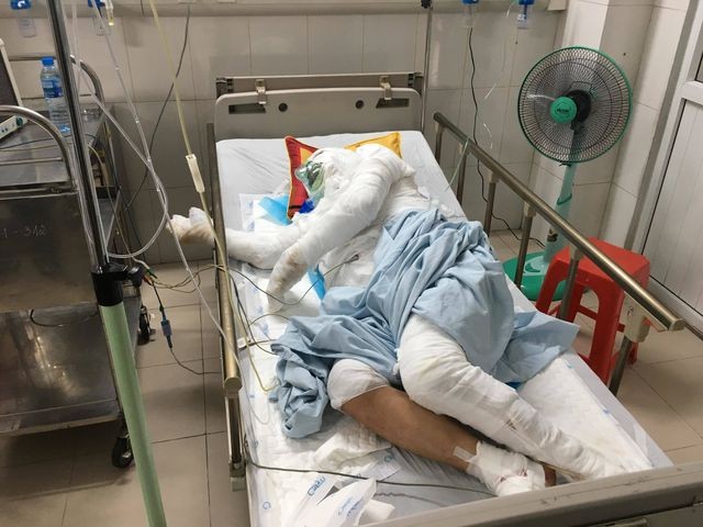 Truy tìm ôtô tông xe ba bánh bốc cháy rồi bỏ trốn khi chủ xe bỏng nặng ảnh 1