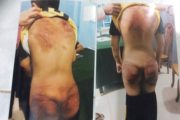 Vụ thầy tu đánh dã man bé 11 tuổi: Trưng cầu giám định thương tật ảnh 1