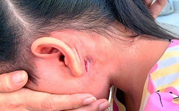 Liên tiếp phát hiện 2 ca nhiễm vi khuẩn 'ăn thịt người' tại Bình Định ảnh 1