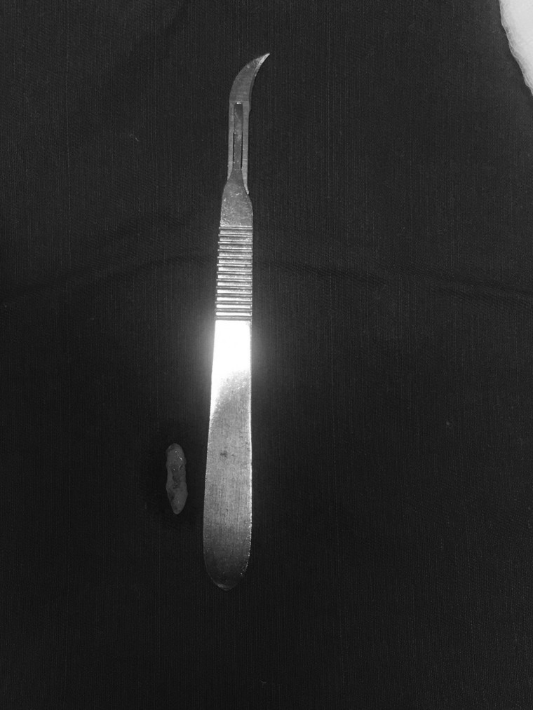 Hy hữu: Răng mọc ngầm chọc thủng hốc mũi ảnh 2