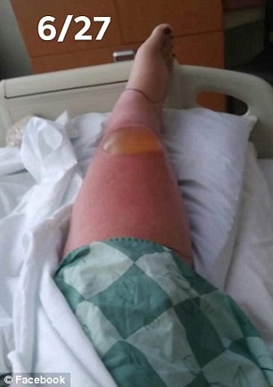 After two days of chills and vomiting, Martinez's leg swelled so she couldn't walk. She arrived at the hospital on June 24, and soon her infection worsened