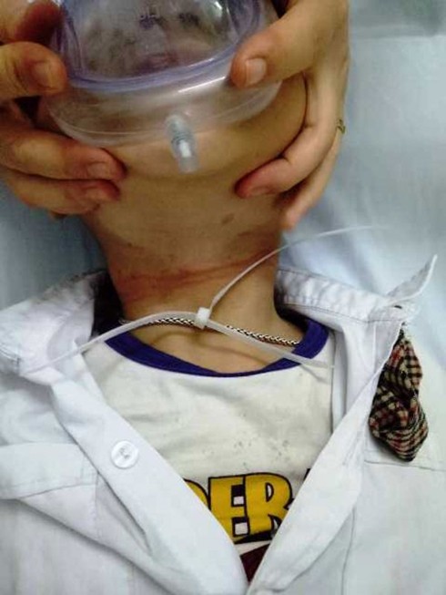 be trai 6 tuoi suyt mat mang vi luon vong day nhua that chat co hinh 1