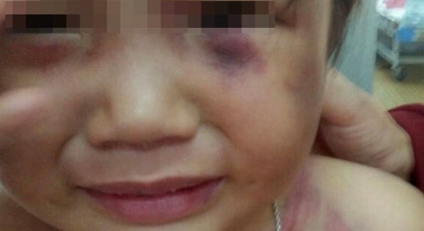 Bình Thuận: Bé 3 tuổi bị cha dượng đánh bất tỉnh chỉ vì 1 câu nói ảnh 1