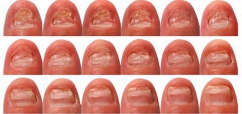 Móng tay có hình trăng lưỡi liềm: Dấu hiệu bệnh tật ảnh 2