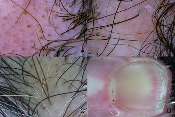 Rùng mình trước sự tái xuất của rận mu ảnh 4