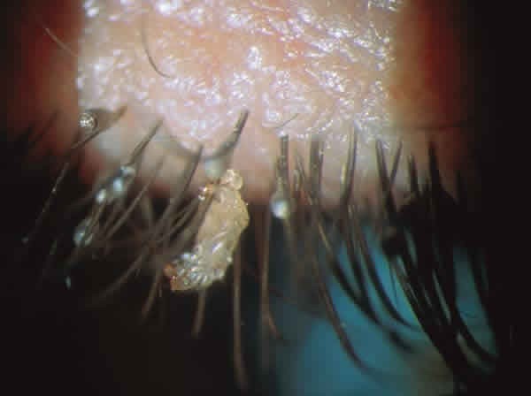 Rùng mình trước sự tái xuất của rận mu ảnh 3