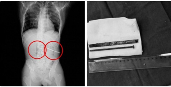 Người đàn ông liều lĩnh nuốt chửng đinh và răng cưa để nhận thưởng ảnh 1