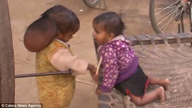 Xót thương trước hình ảnh cô bé 'hai đầu' ở Ấn Độ ảnh 3