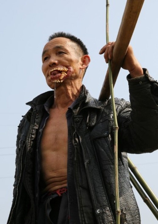 Kinh hãi khuôn mặt người đàn ông biến dạng vì chó sói cắn ảnh 3