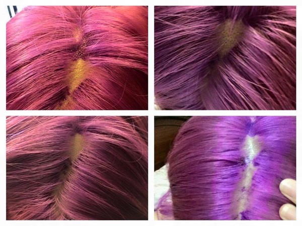 Rùng mình cô gái nhuộm tóc bị 'nổ da đầu' và tóc rụng từng mảng ảnh 1