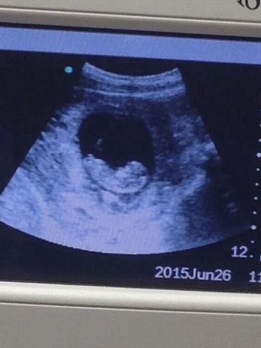 Lý giải những bức ảnh siêu âm thai nhi kì quái gây xôn xao ảnh 1