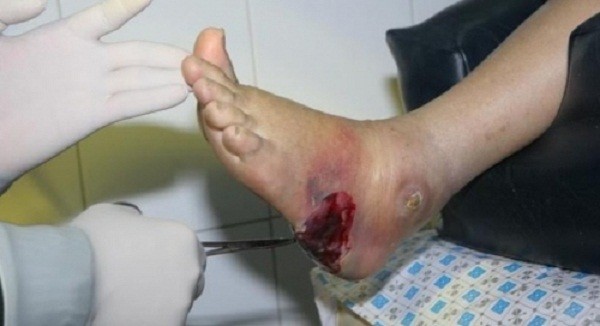 Cẩn thận với những biến chứng quái ác của bệnh tiểu đường ảnh 1