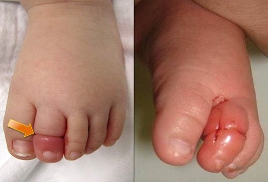 Trẻ có thể mất ngón chân tay chỉ vì... một sợi tóc rụng ảnh 3