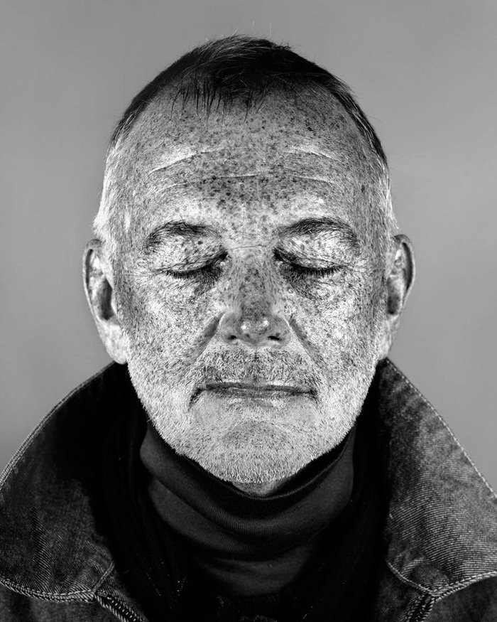 Bộ ảnh gây sốc về tác hại của ánh nắng mặt trời lên da người ảnh 2