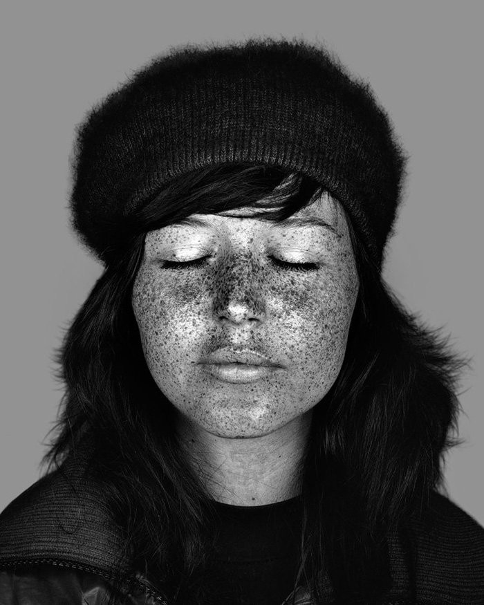 Bộ ảnh gây sốc về tác hại của ánh nắng mặt trời lên da người ảnh 9