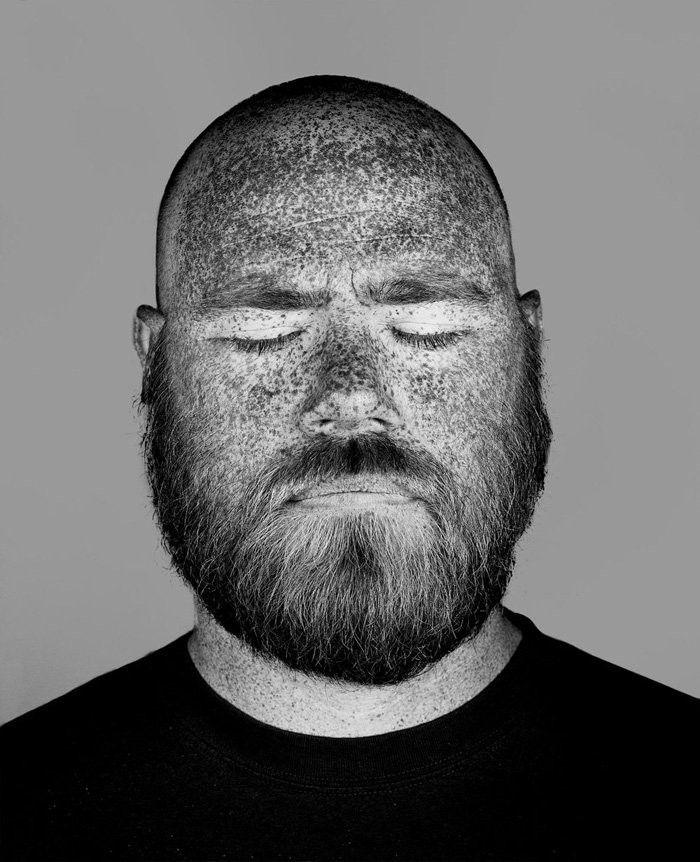 Bộ ảnh gây sốc về tác hại của ánh nắng mặt trời lên da người ảnh 5