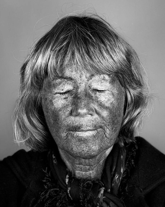 Bộ ảnh gây sốc về tác hại của ánh nắng mặt trời lên da người ảnh 8