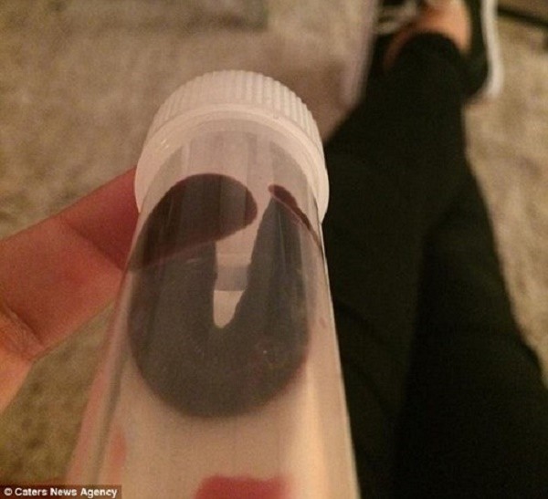 Rùng mình đỉa 'làm tổ' trong hốc mũi người đàn ông ở Ninh Thuận ảnh 3