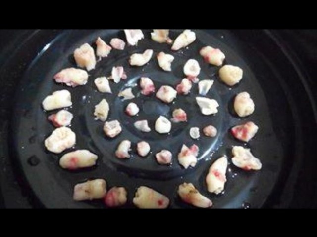 Kỳ lạ bé trai 9 tuổi có 300 chiếc răng ảnh 3