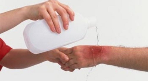 Khi bị dính phải axit bạn cần làm ngay điều này ảnh 1