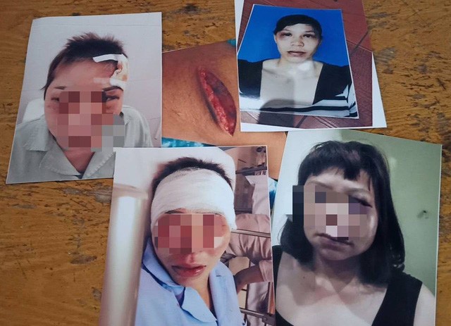 Vụ nữ nhân viên hộ lý bị chồng bạo hành: Đối tượng khai gì với cơ quan công an? ảnh 1