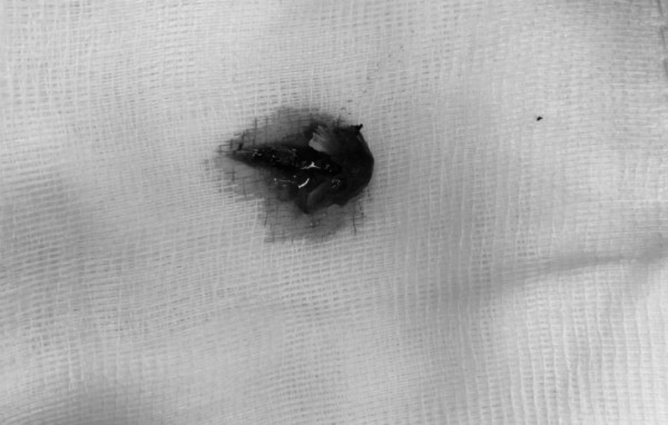 Người đàn ông mất nửa lá phổi sau 5 năm hóc xương cá ảnh 1