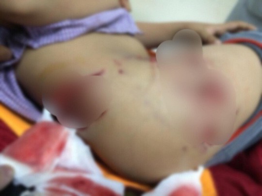 2 bé trai bị chó cắn sâu hoắm tận xương ảnh 1