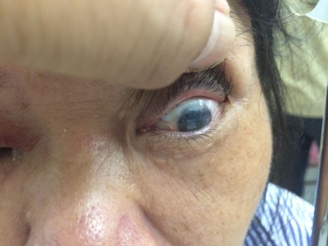 Bị chồng bạo hành, một người phụ nữ bị hỏng nhãn cầu ảnh 1