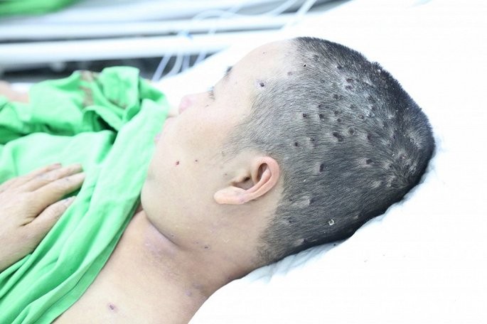 Thêm 3 trẻ đang nguy kịch, suy đa tạng vì ong đốt ảnh 2