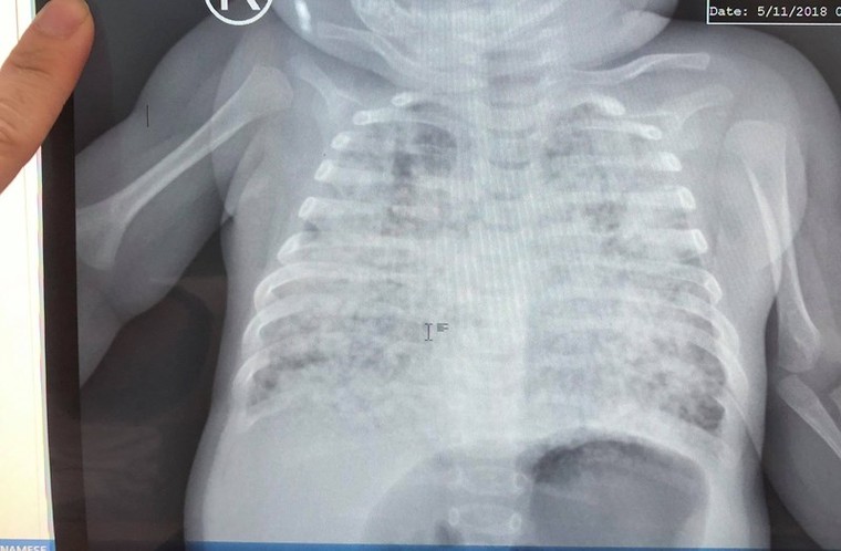 Bị nhiễm lao kê cực nặng, bé 3 tháng tuổi sống sót thần kỳ ảnh 1