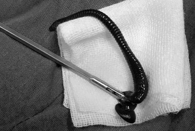 Người đàn ông bị vắt rừng ‘làm tổ’ trong cuống họng ảnh 1