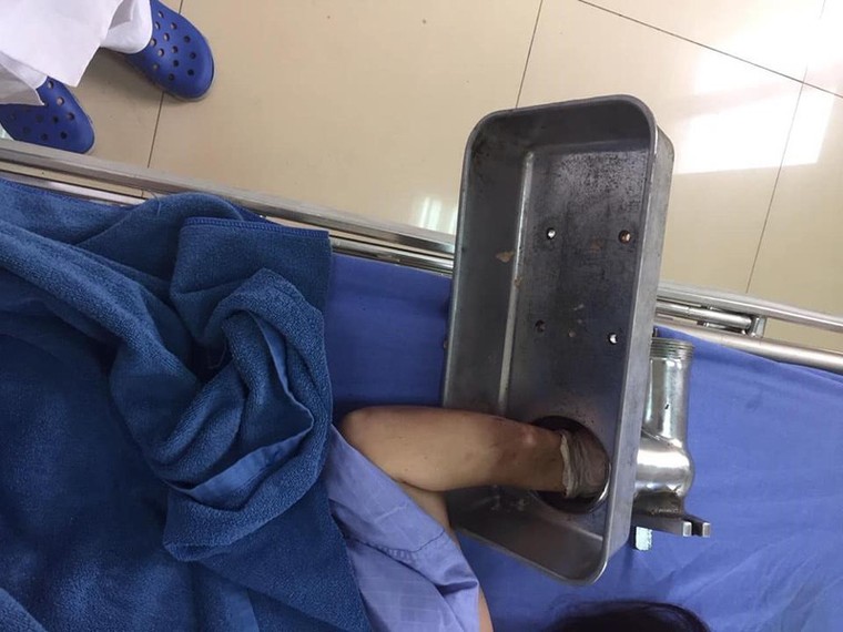 Người phụ nữ cấp cứu với bàn tay nằm trong máy xay thịt ảnh 1