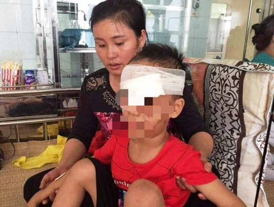 Bé trai 6 tuổi bị chó nhà cắn nát mặt ảnh 1