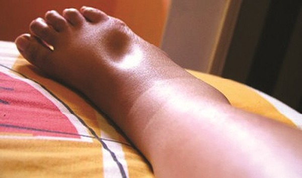 Đi bộ đau và sưng chân có thể mắc căn bệnh gây đột tử ảnh 1