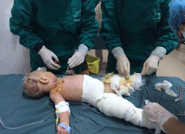 Trẻ bỏng nặng do sự vô ý của cha mẹ ảnh 1