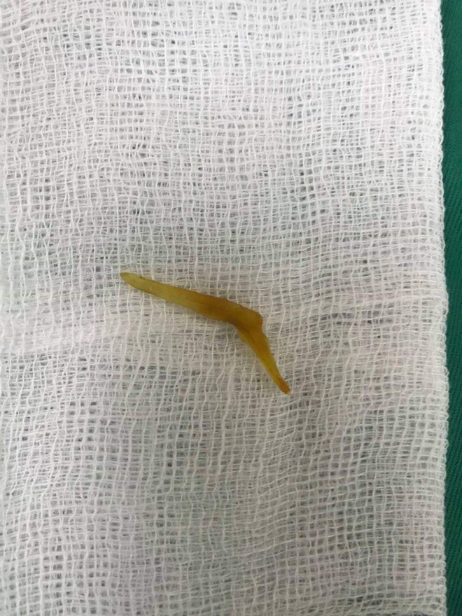 Nuốt xương cá dài 4cm, thanh niên bị thủng ruột non ảnh 1